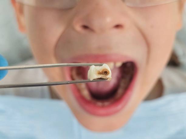 Best Emergency Tooth Extraction in Sullivan, IN